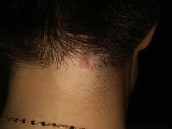 脖子上,瘊子周围一圈皮肤毛发变白,是什么原因?