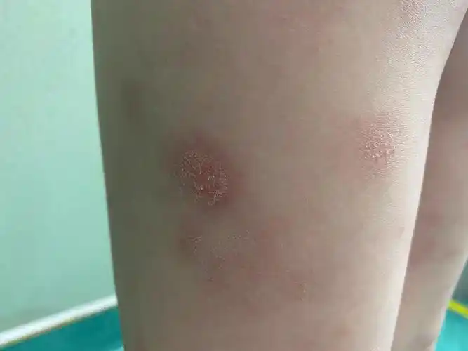 如果患了湿疹怎么办?