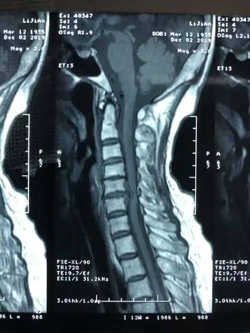 高龄重度颈椎病前路手术治疗 - 好大夫在线