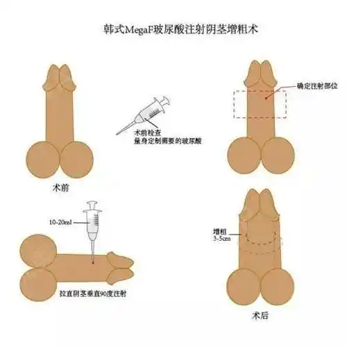 手术方法一,自体脂肪注射增粗术这个手术和其他自体脂肪注射的原理是