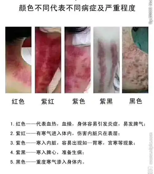 女人湿气重刮痧好还是拔罐好(女人后背刮痧多久刮一次)