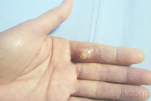 典型图片--化脓性肉芽肿