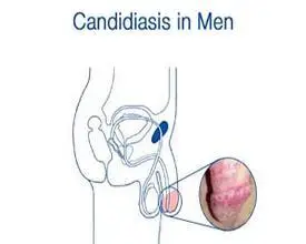 这么有用!龟头炎什么症状表现"欣欣向荣"-第1张图片-若克网
