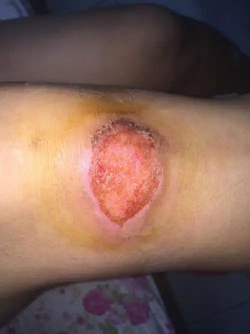 冬天膝盖摔伤了怎么处理能好快点,我腿已经好几天了没见好转啊?