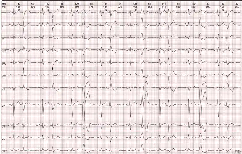 心电图欣赏-善变的qrs波群