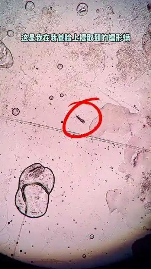 显微镜下放大500倍的螨虫生命力太顽强了硬刚硫磺皂丝毫不怂