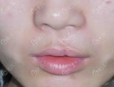 解析:兔唇修复手术已经很多年了,留下的疤痕非常明显还能去掉吗?