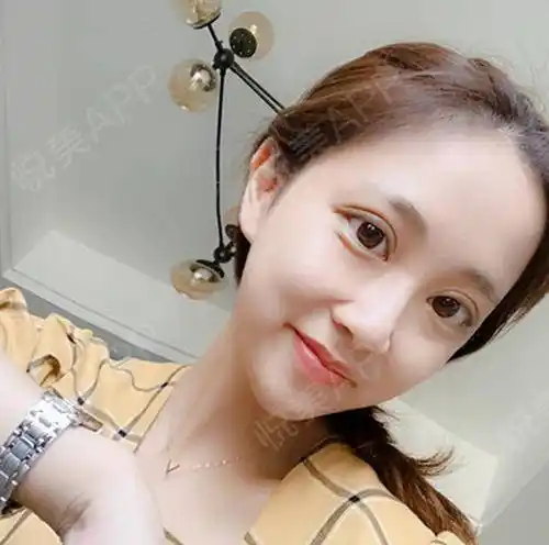 已经大半个月啦,现在双眼皮恢复的很自然