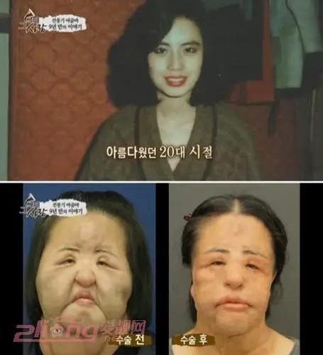 整容失败女星:她们整得比女鬼更可怕_明星整容_医学美容_爱靓网