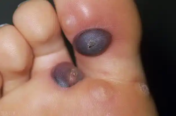 疣的分类与治疗,还有这几种疣也很常见