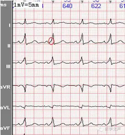 心电图课堂第23期预激综合征