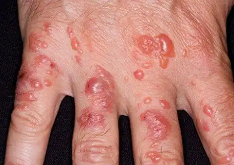 手背湿疹图片6