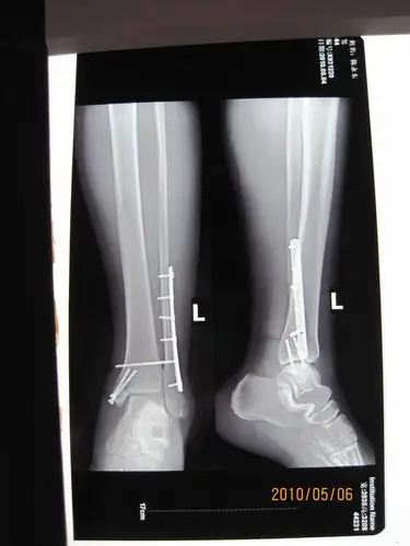 三踝骨折一例讨论分型及治疗