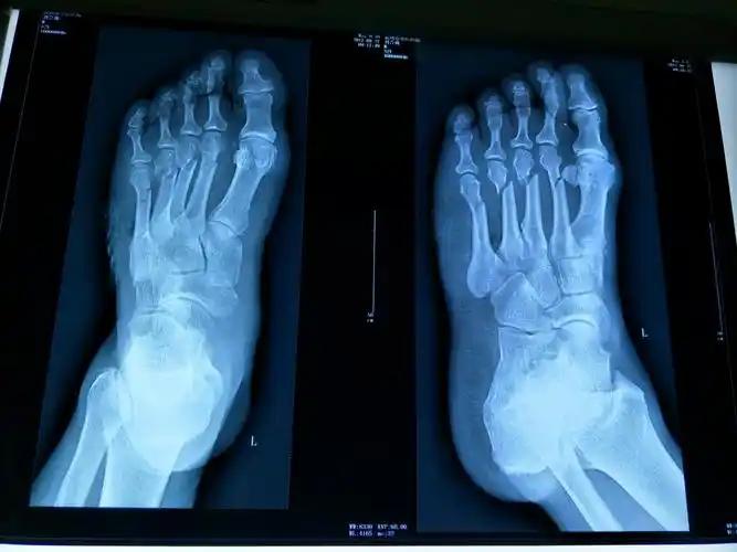 跖骨多发骨折(霸州市中医院骨科李艳阳团队)~创伤篇