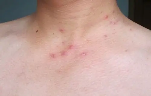 一个月会出现哪些艾滋病症状