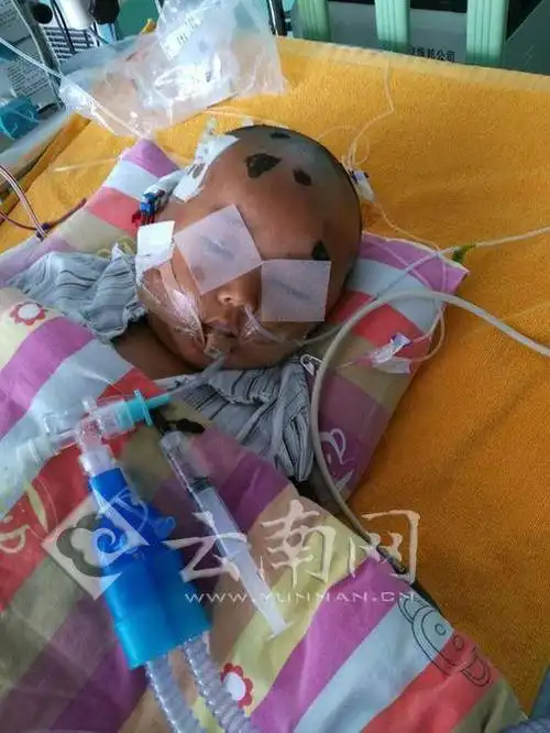 2岁男童遭毒蜂叮咬 昏迷10天仍未脱离生命危险