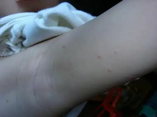 病毒性皮肤病—疣