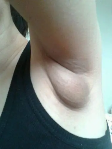 胳肢窝长肉疙瘩图片4