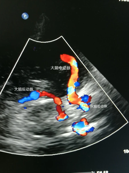 脑动脉彩超在脑血管疾病中应用