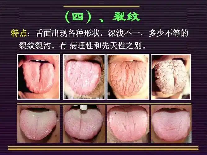 中医诊断学―舌诊图文祥解·舌象分析要点