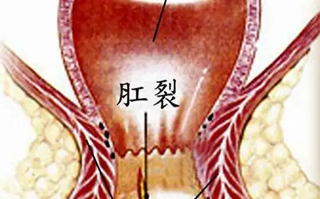 试管婴儿之生孩子导致肛裂怎么办
