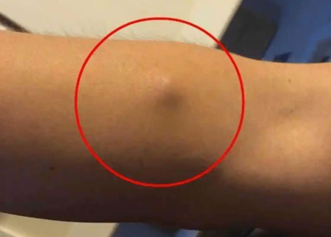 与脂肪瘤的柔软和光滑不同,淋巴瘤可明显触摸到皮下的肿块呈椭圆或