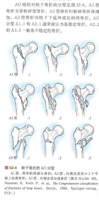 股骨粗隆间骨折的ao分型
