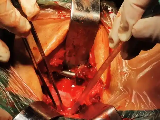 首例第4腰椎椎体滑脱并第4,5椎管狭窄经后路切开减压,椎弓根螺钉内