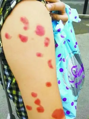 出租房床垫里暗藏小臭虫 咬得租客浑身红包(图)