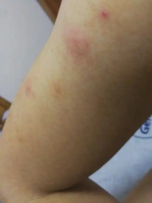 身上起红疙瘩,主要集中在胳膊和手上.