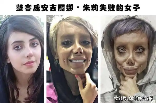 整容失败的代价:据说因为整容而毁掉了自己容貌的6个人_鼻子