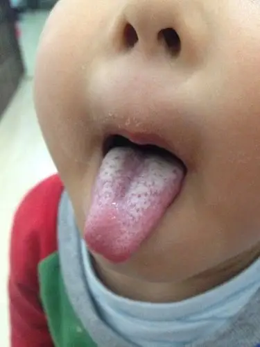 四岁舌苔白晚上睡觉鼻塞重