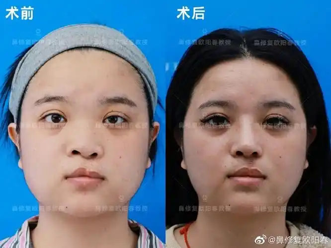 唇裂鼻畸形患者菲菲术前术中术后恢复全纪实