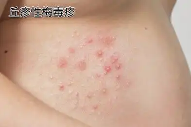 梅毒疹是感染梅毒后所表现出的二期梅毒临床症状之一,可分为斑疹性