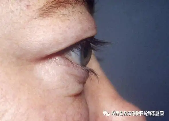 长期眼皮浮肿甲亢真的那么近
