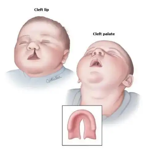 出生时就存在的,被称为"出生缺陷",我们今天讨论的唇腭裂便是其中一种