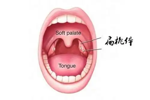 用中药来治疗小儿和成人扁桃体化脓怎样配伍才能得心应手