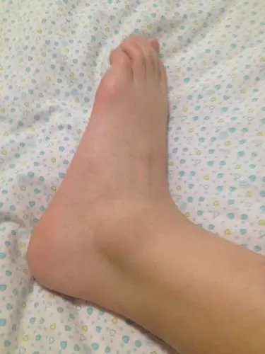 我的左脚踝扭伤了,当时不敢直立行走!