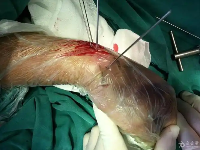 经皮螺钉固定腕舟骨骨折