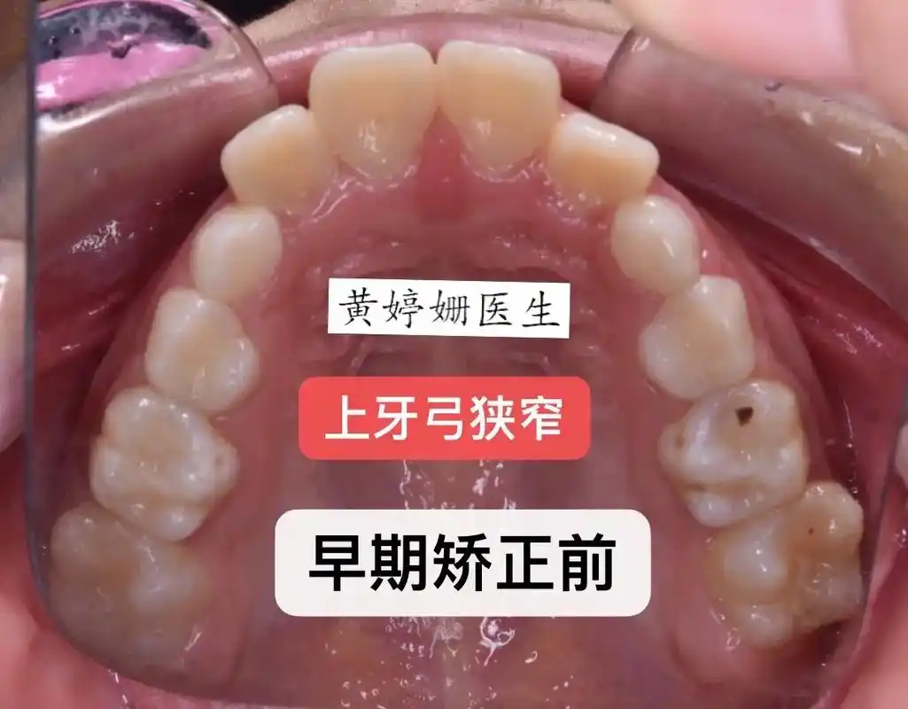 上突下缩大龅牙,有三种治疗方法 1.早期矫正,拓宽上 - 抖音