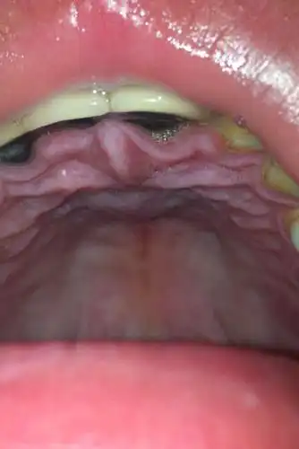 口腔内舌头上方红肿,整个嘴巴都牵扯的痛