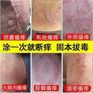 狸俚米男康喷剂龟头炎型私处潮湿异味瘙痒健龟草本宁乳膏乐康正品