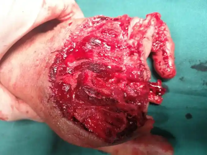 清创后大体照片