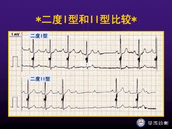 房室传导阻滞-临床上常见的一种心脏传导阻