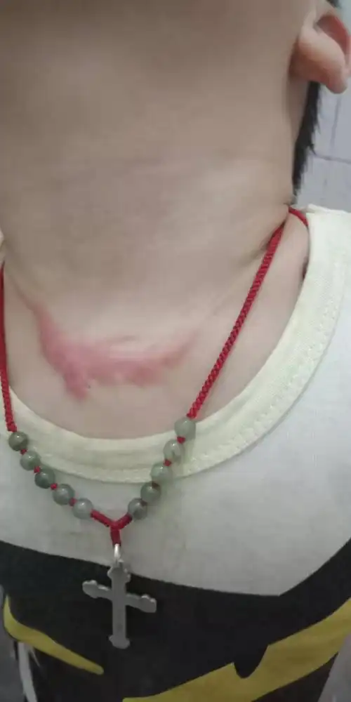 我家二宝去年11月被开水烫伤了,现在脖子里有比较明显的疤痕,然后这疤