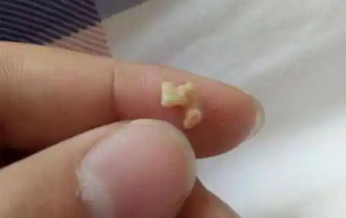 原创嘴里抠出小米粒捏碎后臭气熏天其实是身体的求救信号