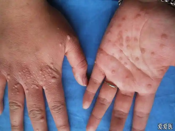 典型病例寻常疣