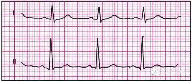 最全面的异常心电参考图建议收藏