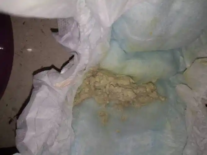 宝宝吐奶很严重,拉屎是奶白色的.还老是出汗.请问怎么办?