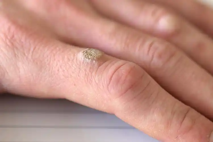 你长的瘊子是公还是母